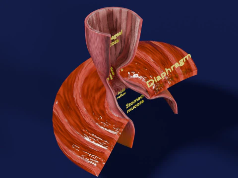 Gastro oesophageal reflux disease 3D Model