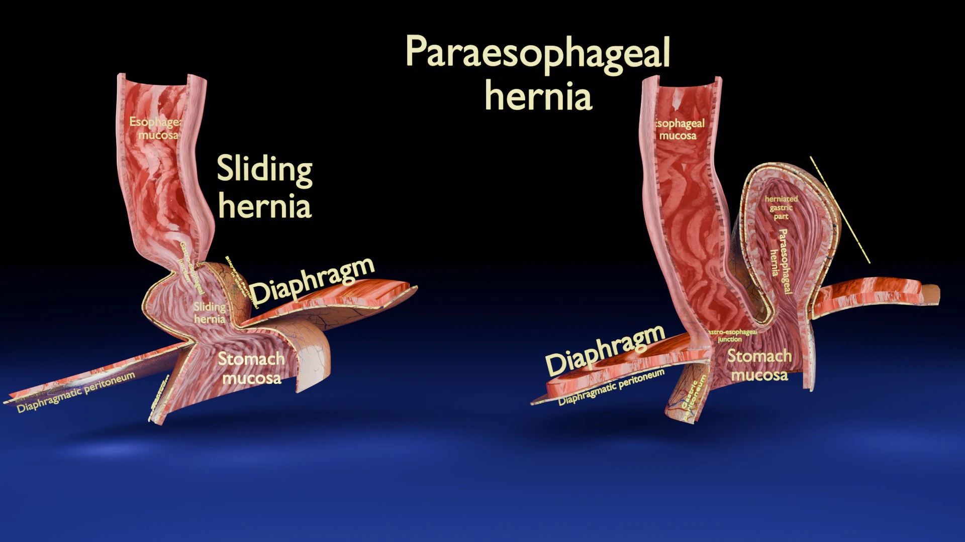 Hiatal hernia stomach sliding paraesophageal 3D Model .c4d .max .obj .3ds .fbx .stl .blend 