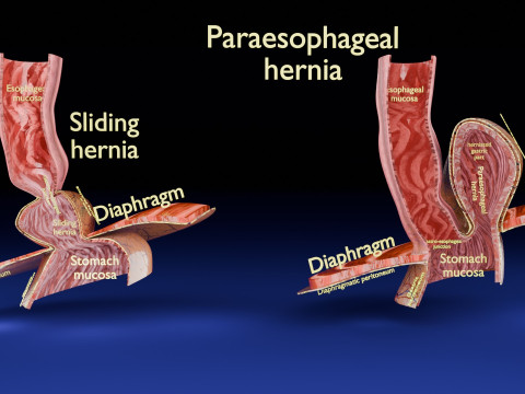 Hiatal hernia stomach sliding paraesophageal 3D मॉडल