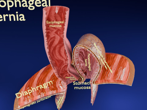 Hiatal hernia stomach sliding paraesophageal 3D Model