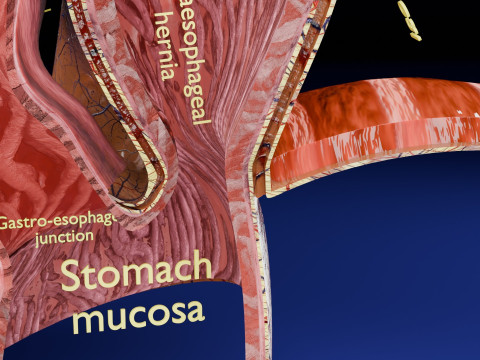 Hiatal hernia stomach sliding paraesophageal 3D Model