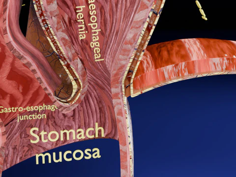 Hiatal hernia stomach sliding paraesophageal 3D Model