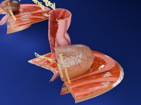 Hiatal hernia stomach sliding paraesophageal 3D Model