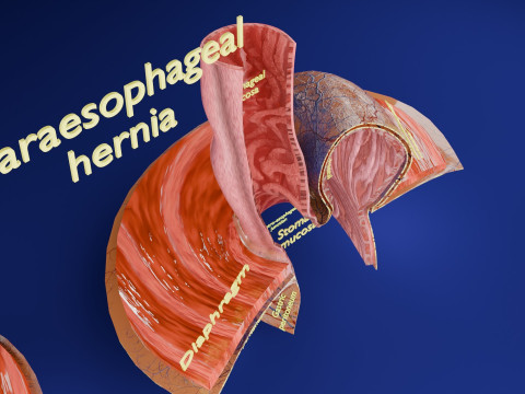 Hiatal hernia stomach sliding paraesophageal 3D Model