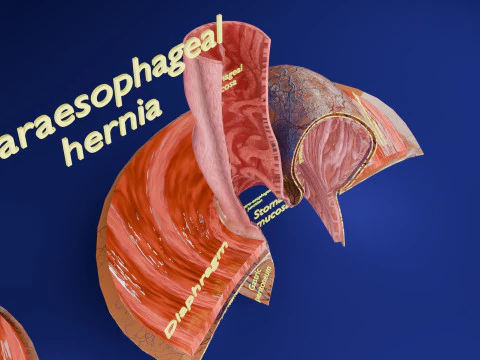 Hiatal hernia stomach sliding paraesophageal 3D Model