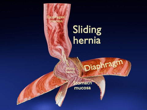 Hiatal hernia stomach sliding paraesophageal 3D Model