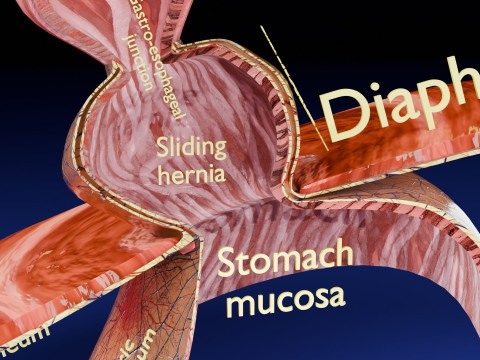 Hiatal hernia stomach sliding paraesophageal 3D Model