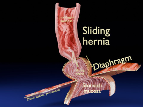 Hiatal hernia stomach sliding paraesophageal 3D Model