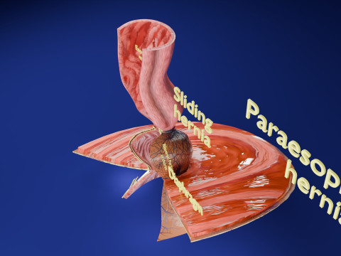 Hiatal hernia stomach sliding paraesophageal 3D Model