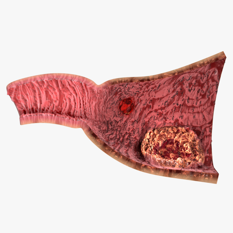 Gastric Ulcer Benign versus Malignant Modello 3D .c4d .max .obj .3ds .fbx .stl .blend
