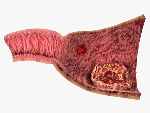 Gastric Ulcer Benign versus Malignant Modelo 3D