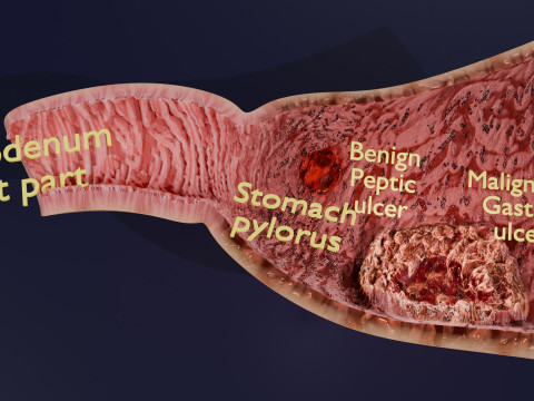 Gastric Ulcer Benign versus Malignant Modello 3D