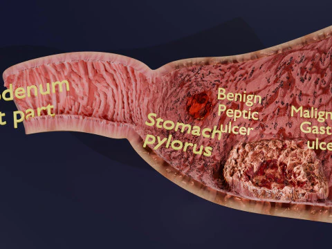 Gastric Ulcer Benign versus Malignant 3D Model