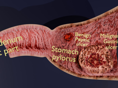 Gastric Ulcer Benign versus Malignant Modello 3D