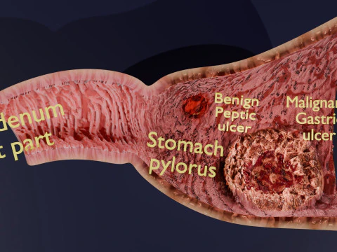 Gastric Ulcer Benign versus Malignant 3D Model