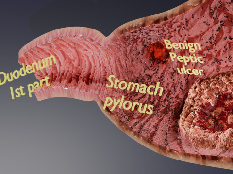 Gastric Ulcer Benign versus Malignant Modello 3D