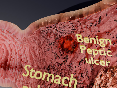 Gastric Ulcer Benign versus Malignant Modello 3D