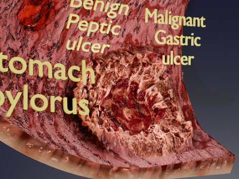 Gastric Ulcer Benign versus Malignant Modello 3D