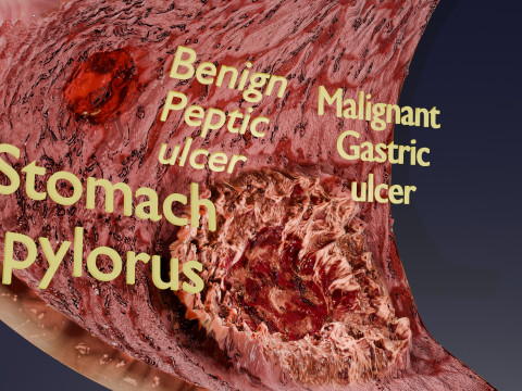 Gastric Ulcer Benign versus Malignant Modello 3D