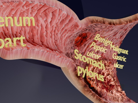 Gastric Ulcer Benign versus Malignant Modello 3D