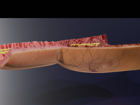 Gastric Ulcer Benign versus Malignant Modello 3D