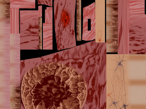 Gastric Ulcer Benign versus Malignant Modello 3D