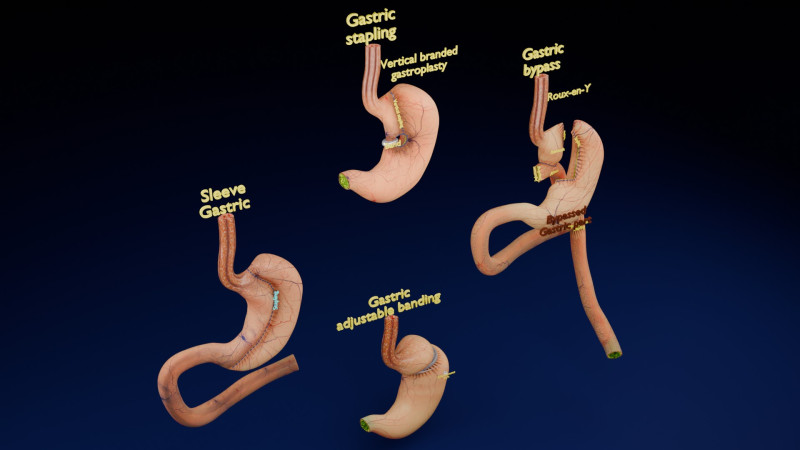 Bariatric Surgery Types 3D Модель .c4d .max .obj .3ds .fbx .stl .blend 