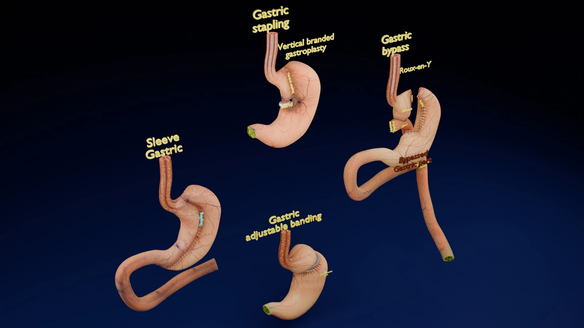 Bariatric Surgery Types 3D Model .c4d .max .obj .3ds .fbx .stl .blend 