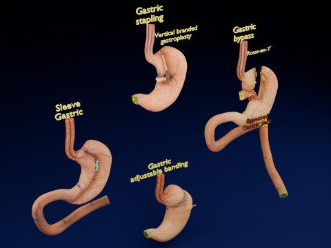 Bariatric Surgery Types 3D मॉडल