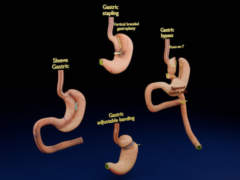 Bariatric Surgery Types 3D Модель