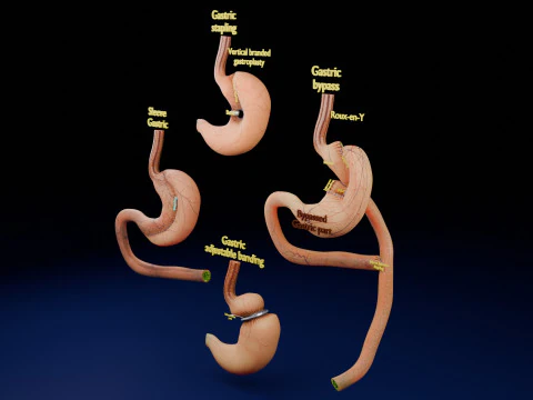 Bariatric Surgery Types 3D Model