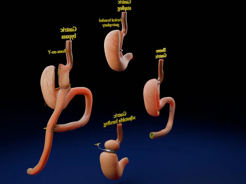 Bariatric Surgery Types 3D Model