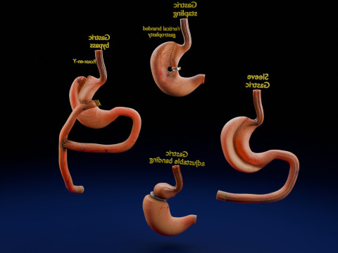 Bariatric Surgery Types 3D Модель