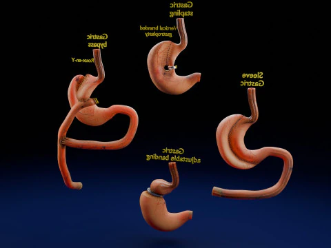 Bariatric Surgery Types 3D Model