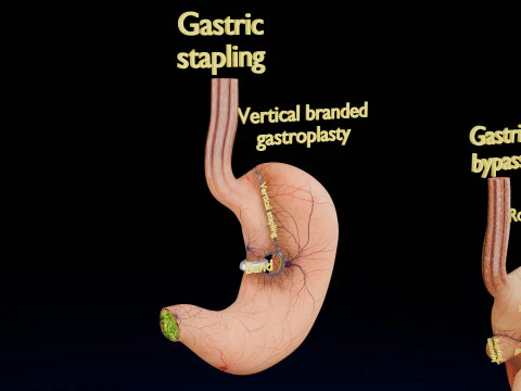 Bariatric Surgery Types 3D Model