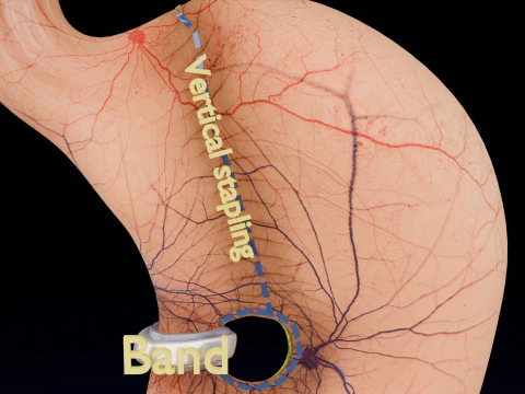 Bariatric Surgery Types 3D Model
