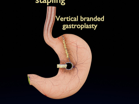 Bariatric Surgery Types 3D Модель