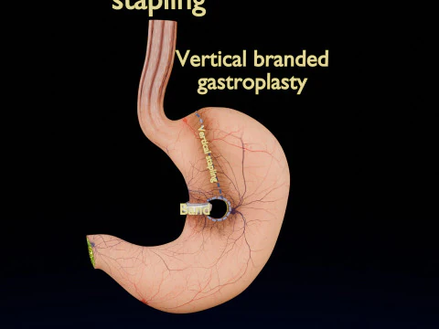 Bariatric Surgery Types 3D Model