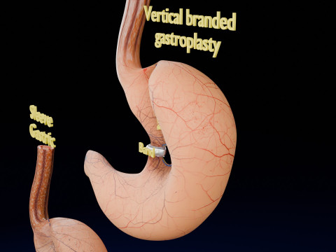 Bariatric Surgery Types 3D Модель