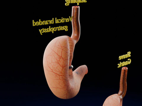 Bariatric Surgery Types 3D Model