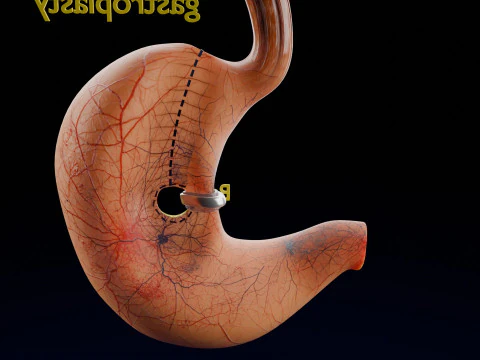 Bariatric Surgery Types 3D Model