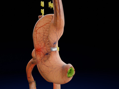 Bariatric Surgery Types 3D Модель