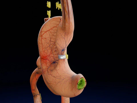 Bariatric Surgery Types 3D Model