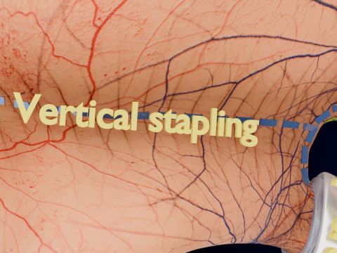 Bariatric Surgery Types 3D Модель