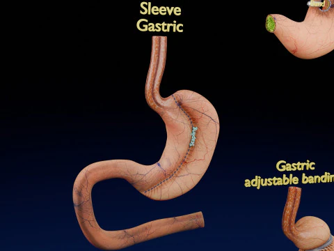 Bariatric Surgery Types 3D Model