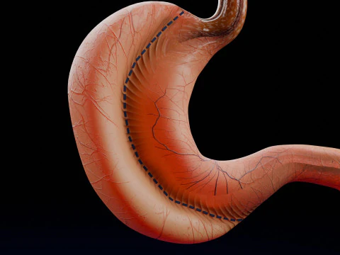 Bariatric Surgery Types 3D Model