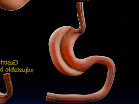 Bariatric Surgery Types 3D Модель