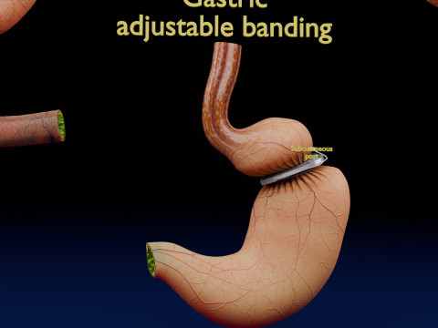 Bariatric Surgery Types 3D Модель