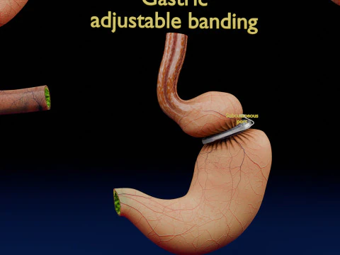 Bariatric Surgery Types 3D Model