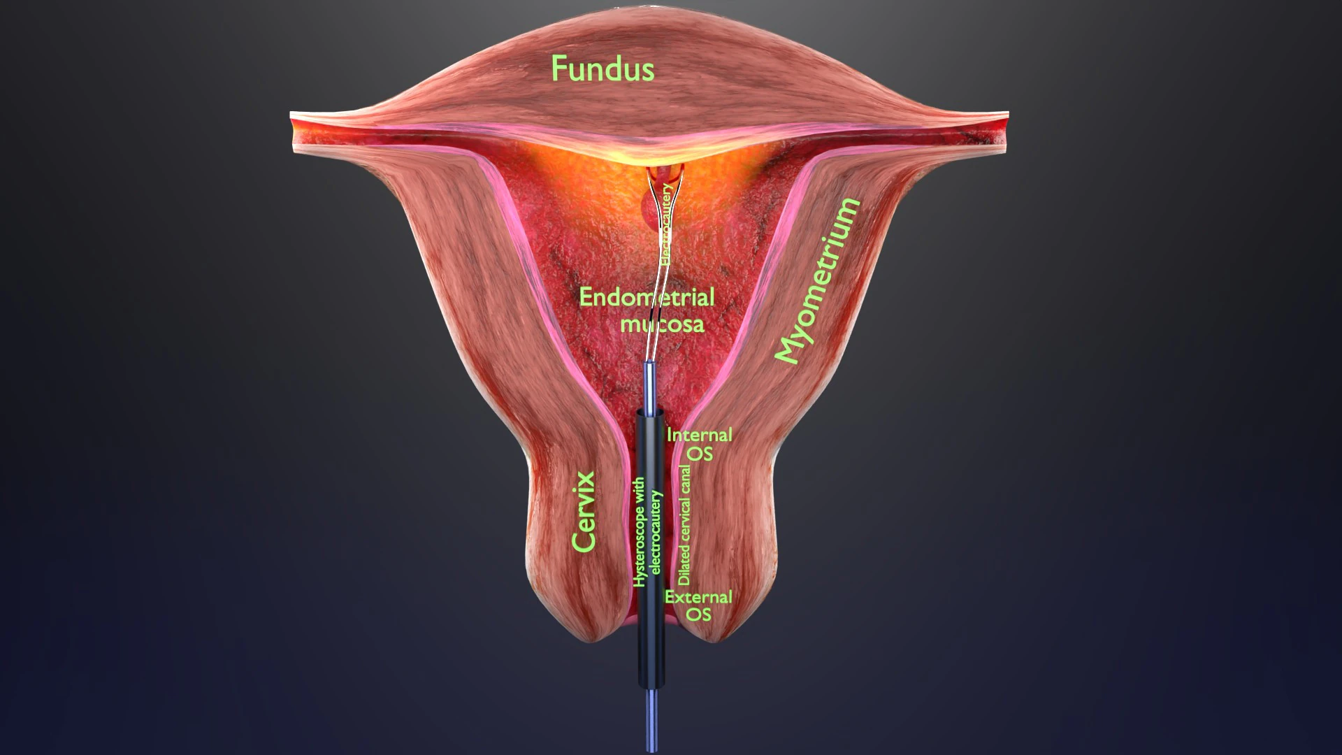 Endometrial Polyp Electrocautery 3D Model .c4d .max .obj .3ds .fbx .stl .blend 